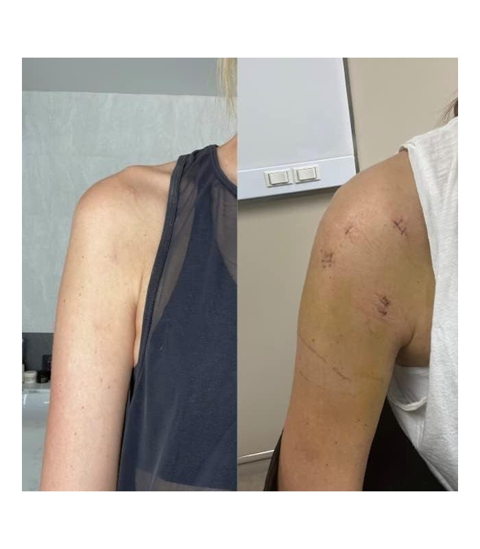 Mederma Advanced Scar Gel 1x Daily Reduz a Aparência de Velhas Novas Cicatrizes 1 Médico Farmacêutico Marca Recomendada para Cic